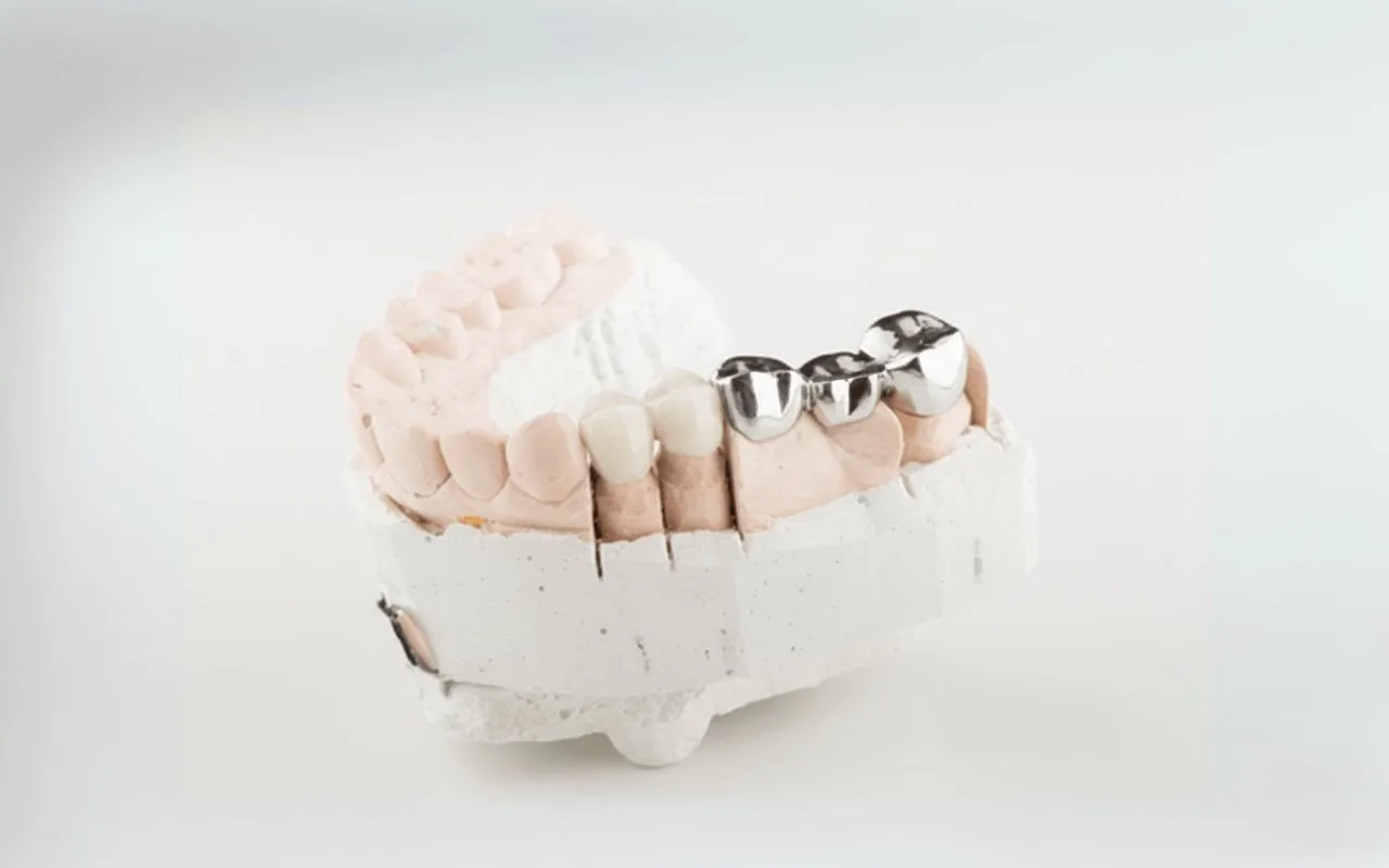 Benefits of Dental Bridges