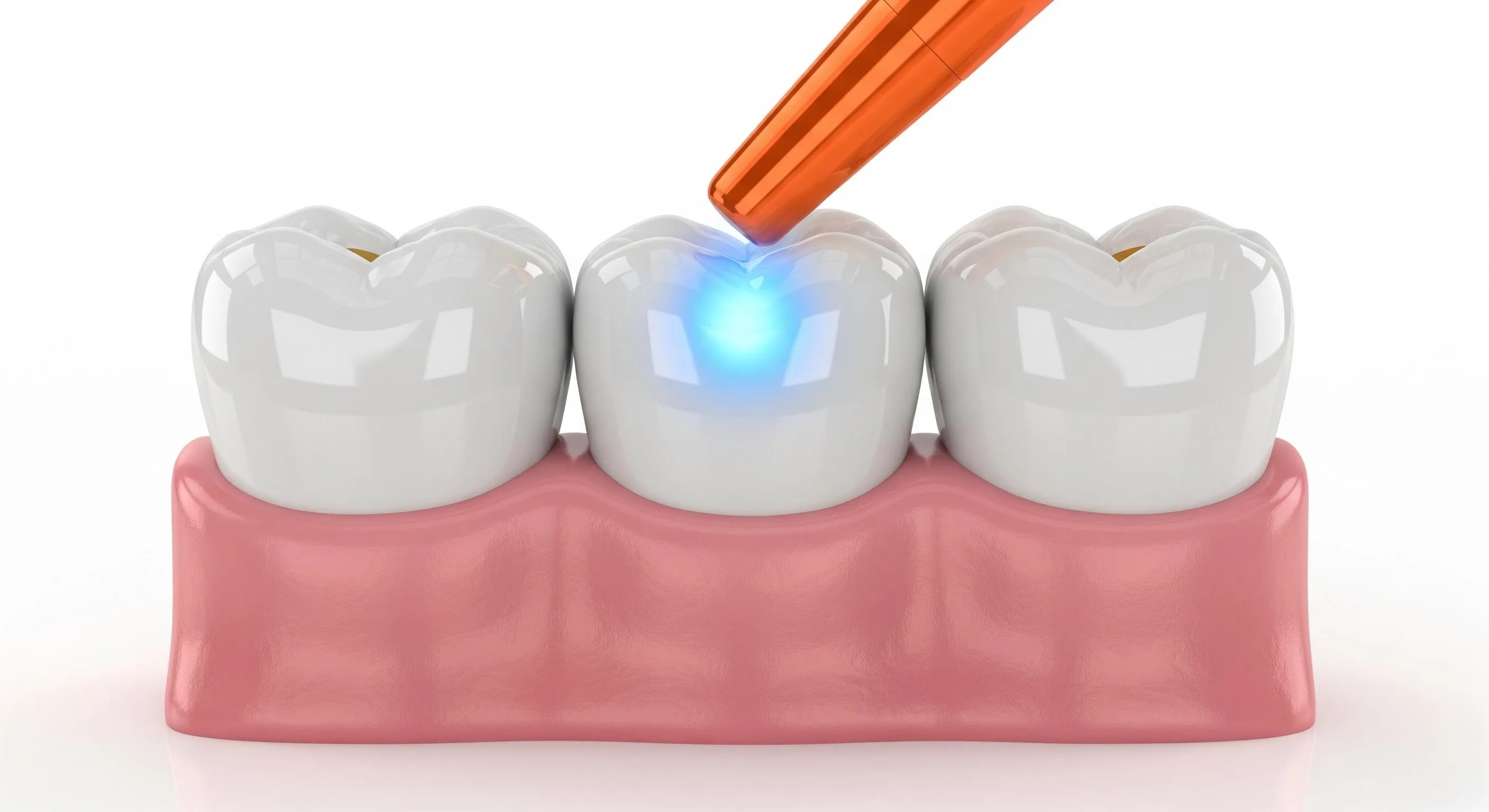 Composite Fillings Cost and Pricing Information in West Columbia
